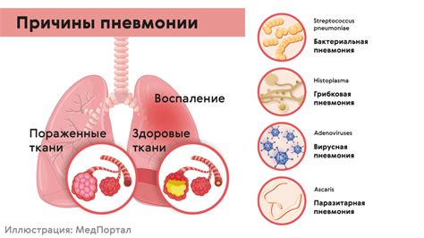 Влияние возраста на обратное развитие пневмонии