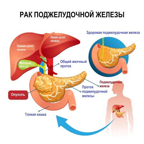 Лечение и прогноз при не локализованной поджелудочной железе